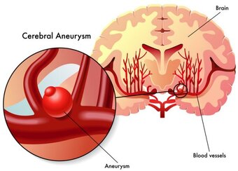 Cerebral Aneurysm © rob3000 - fotolia