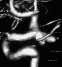 3D illustration of the same aneurysm