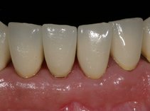 Zustand der verlängerten Zähne nach Versorgung mit einem Langzeitprovisorium