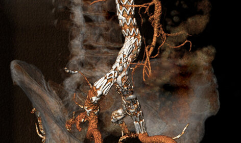 Ein Drahtgeflecht, das über die Leistenvene bis an den Ort der Schlagader vorgeschoben wird, kann einen lebensgefährlichen Riss der Bauchaorta verhindern. ©Universitätsklinikum Freiburg Ein Drahtgeflecht, das über die Leistenvene bis an den Ort der Schlagader vorgeschoben wird, kann einen lebensgefährlichen Riss der Bauchaorta verhindern. ©Universitätsklinikum Freiburg