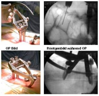 Minimal invasive vertebral fusion