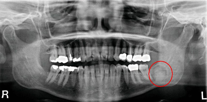 Ossifizierendes Fibrom 