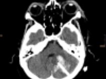 Intracerebral hemorrhage after surgical treatment