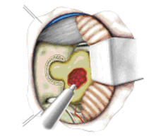 Entfernung eines Tumors