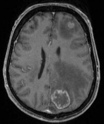 Metastases in the brain