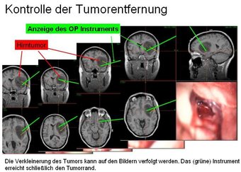 Removal of brain tumour