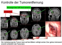 Kontrolle der Tumorentfernung