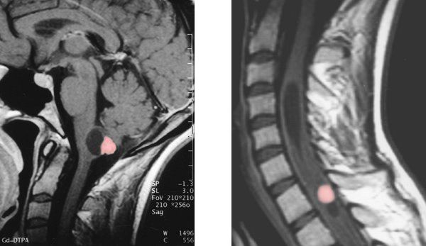 Hämangioblastom im Hirnstamm (links) und im Rückenmark (rechts)